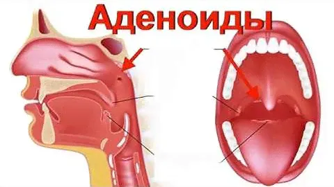 Как вылечить АДЕНОИДЫ - 2 СЕКРЕТ успешного выздоровления  без операции ПРОВЕРЕНО ! 100% РЕЗУЛЬТАТ !